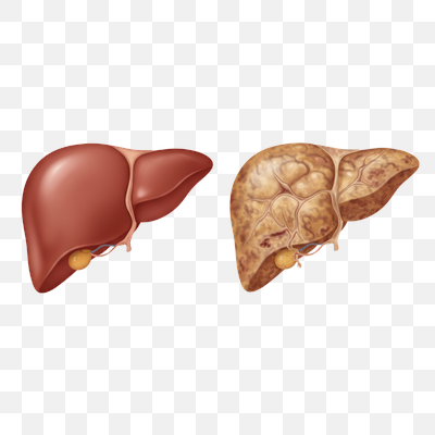 Healthy Liver vs. Liver with Fibrosis: A Visual Comparison